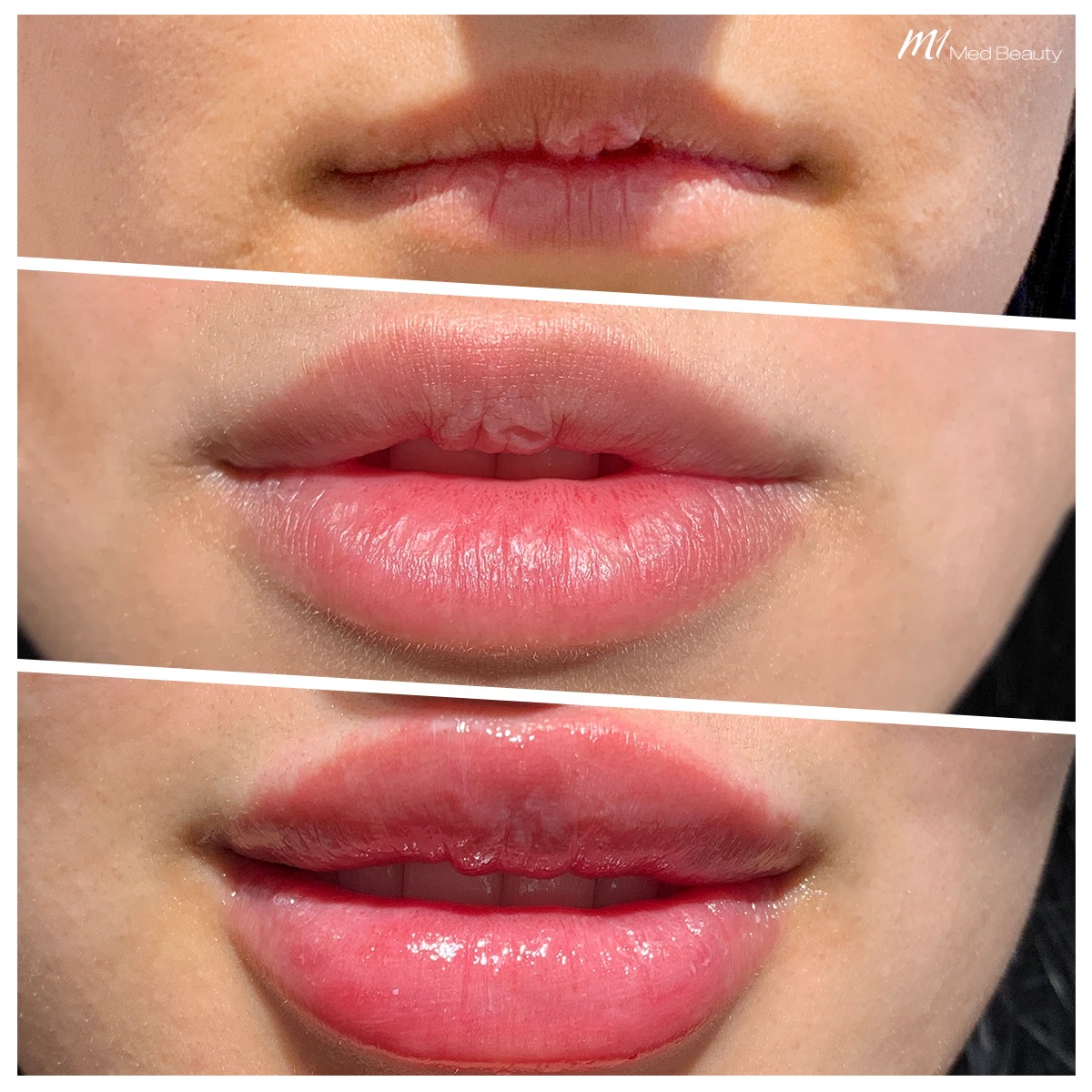 lip-fillers-191214_BA.jpg